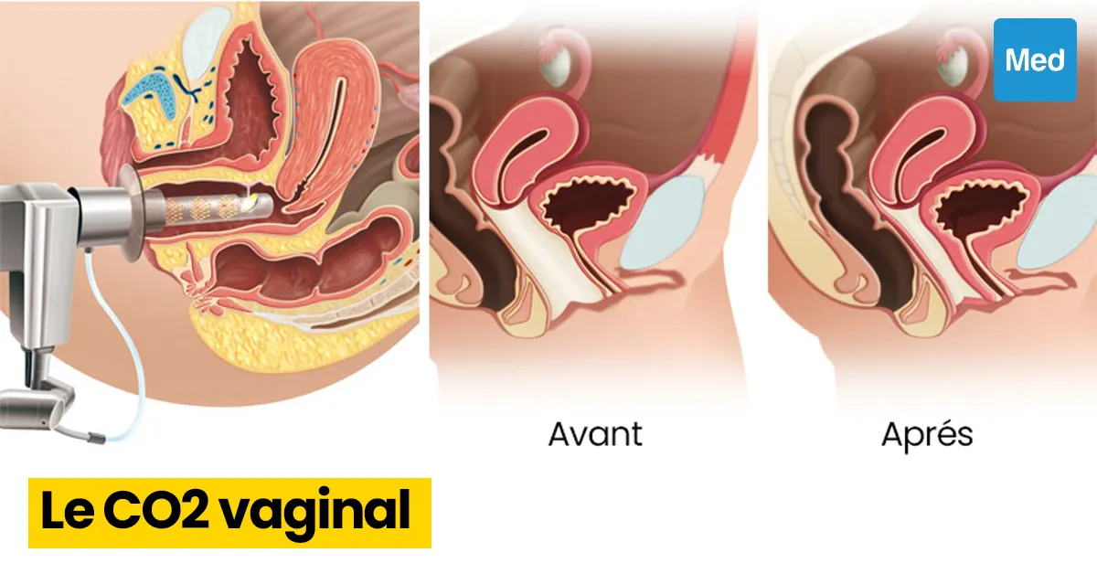 CO2 vaginal : une solution efficace pour les problèmes vulvo-vaginaux